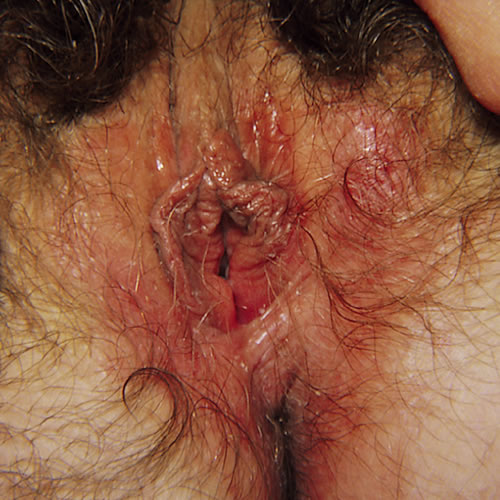 Eczematous dermatitis
