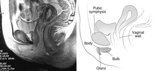 Figure F-14: MRI showing boomerang shape of the glans clitoris