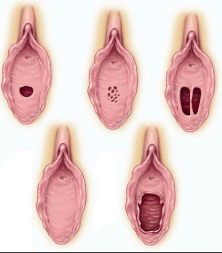 Figure F-19: Hymenal variations: Top row, left: normal virginal hymen. Top row, middle: cribriform hymen. Top row, right: septate hymen. Bottom row, left: imperforate hymen. Bottom row, right: ruptured hymen.