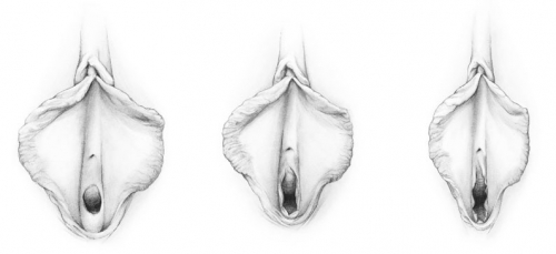 Figure F-20: Hymen before penetration, after penetration, and after childbirth