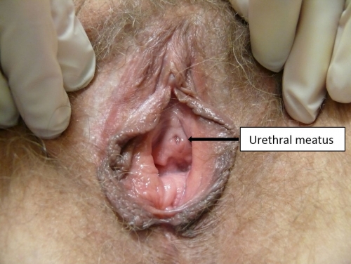 Figure F-24: Urethral meatus