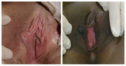 Figure F-26: Examples of asymmetry of the labia minora. 