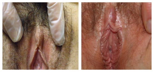 Figure 38: Examples of hypertrophy of the clitorisBoth photos represent women who were treated for biopsy-proven lichen sclerosus with testosterone.