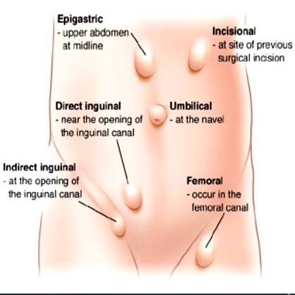 Figure F-42: Possible locations of herniae