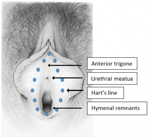 P: Vaginal secretions, pH, microscopy, and cultures - Vulvovaginal