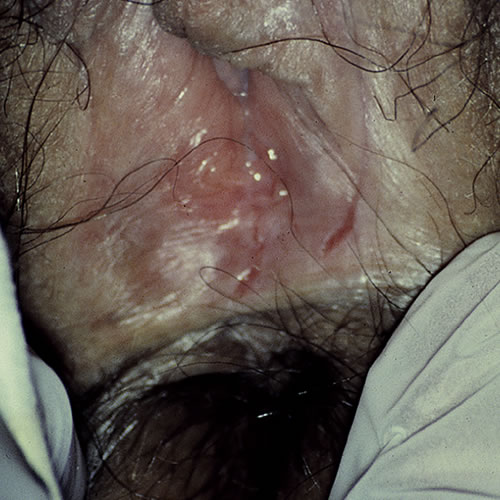 Fissures of the vulva