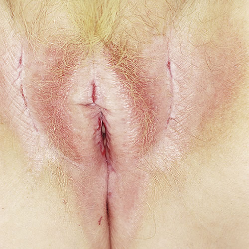 Fissures of the vulva