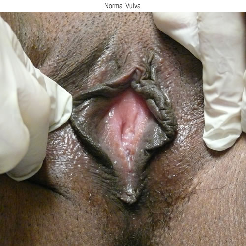 Normal appearing vestibule with no erythema and no secretions apparent.