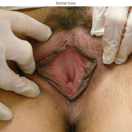 Normal appearing vestibule with no erythema and no secretions apparent.