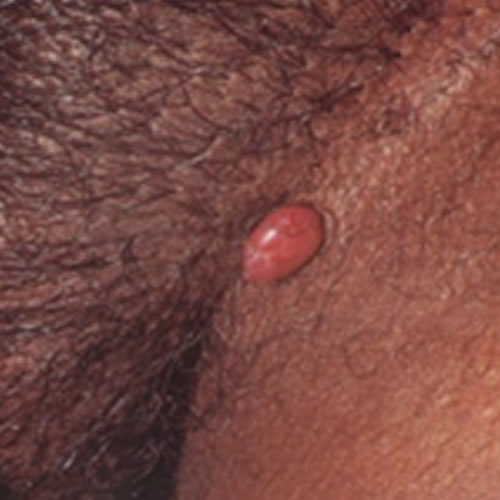 Pyogenic Granuloma