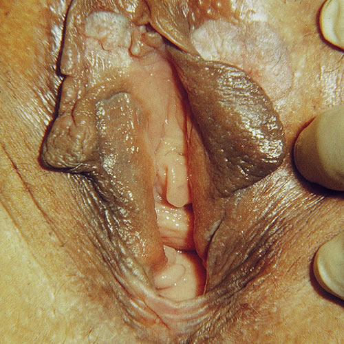Vulvar Intraepithelial Neoplasia (VIN)
