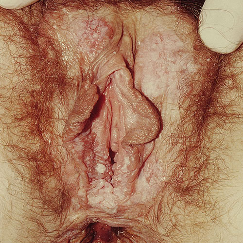 Vulvar Intraepithelial Neoplasia (VIN)