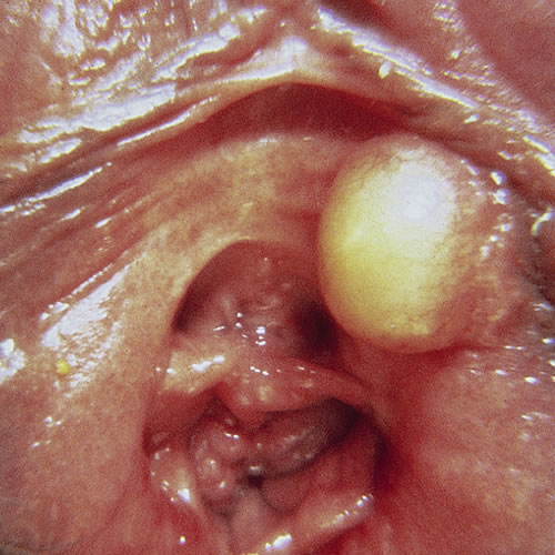 Vestibular Mucinous Cyst