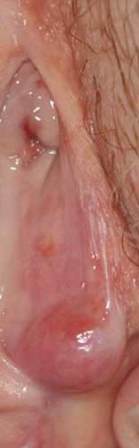 dermatological-terminology-cyst