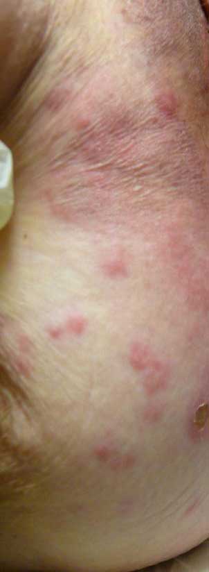 dermatological-terminology-rash
