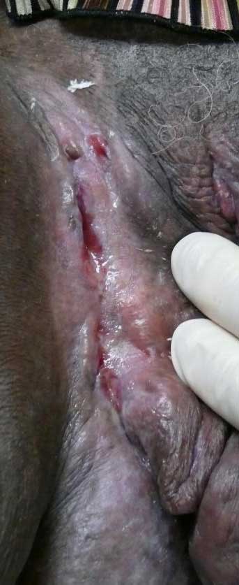 dermatological-terminology-ulcer1