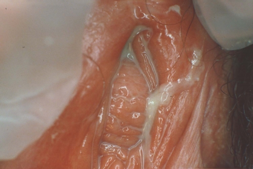 desquamative vaginitis